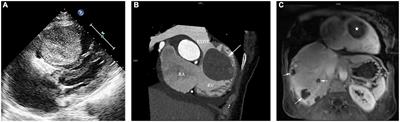 Cardiac venous malformation concurrent with multiple hepatic venous malformations: A case report